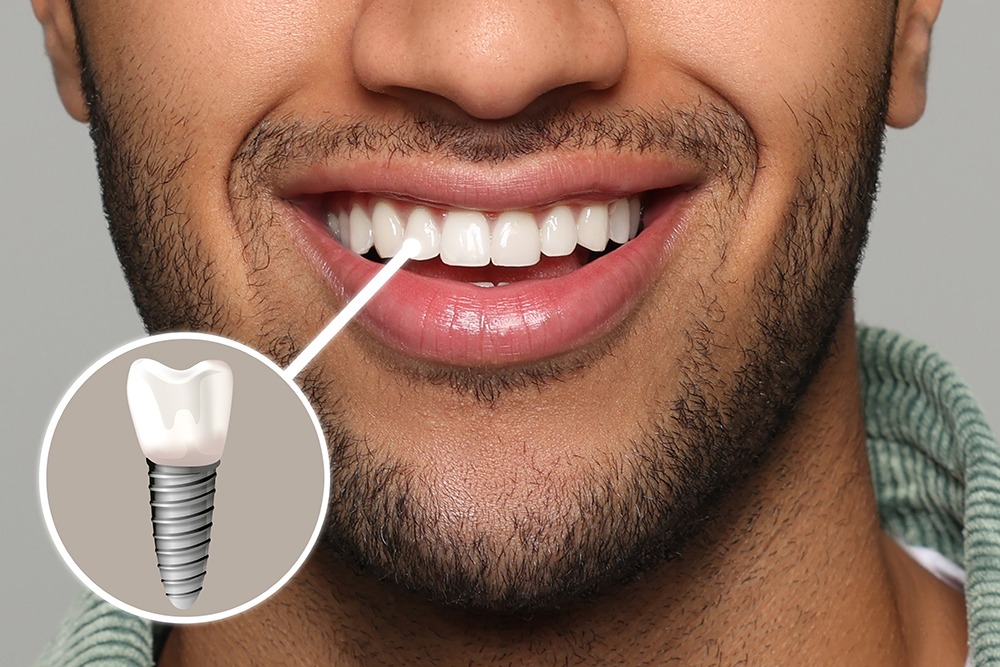 Dental Implants vs. Dentures & Bridges